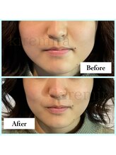 キレミラ 麻布十番店/エラ張り編