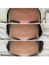 プラセル(Placer)/回数を重ねるごとに美しく☆