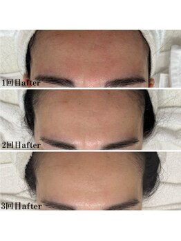 プラセル(Placer)/回数を重ねるごとに美しく☆