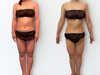 サルサナ(Salu Sana)/before→after