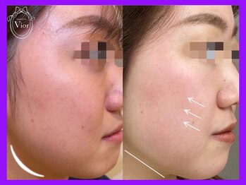 ハーブピーリング 名古屋/むくみ撃退！？ 小顔スッキリ！