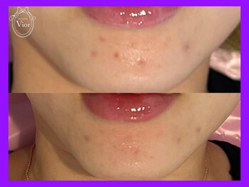 ヴィオール 名古屋栄店(VIOR)/光ショット施術 肌周期短縮!