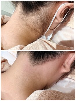 ウェイビーズ エステ(wavy's.esthetic)/【ビフォーアフター】うなじ脱毛