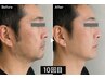 【初めての方向け】メンズ顔脱毛/清潔感UP男性専門◎顔脱毛体験 ￥3,300