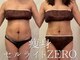 ニコ(nico)の写真/ダイエットで結果を出したい方へ。全身痩せたい願いを叶える脂肪燃焼分解ケア◎