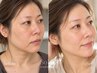 【3回集中38,400円】ダクトピール(顔+首)｜3回を2週間ごとにピーリングケア
