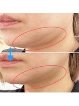 みつばちさろん/【ブラックスタンプ】顎下