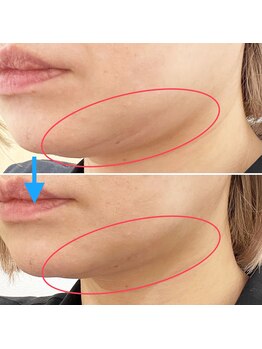 みつばちさろん/【ブラックスタンプ】顎下