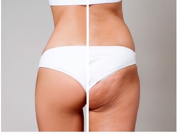 ヨサパーク ラ メール(YOSA PARK La Mer)の写真/痩せにくい太もも・腰周り脂肪をしっかりケア！下半身集中の痩身ケアコースで頑固な脂肪スッキリ♪