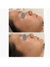 シェルビー(Cielbe.)/陶肌トリートメント