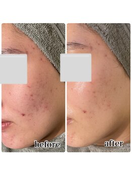 レピア つくば店(LEPIA)/1回ビフォーアフター