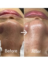 ブルームーン(Blue Moon)/ハイドラ毛穴洗浄