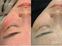 ケアナ 麻布十番店(CareNa)/赤みにも効果◎