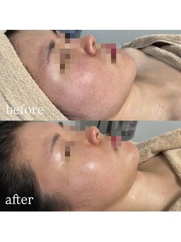 ビューティーサロン プティ(beauty salon petite)/毛穴/赤ら顔/ポレーション