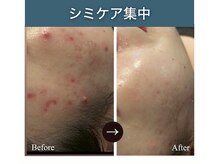 シアラ(SHIARA)/シミケア後の変化