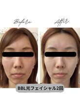 プレジール 大野城店(plaisir)/BBL光フェイシャル