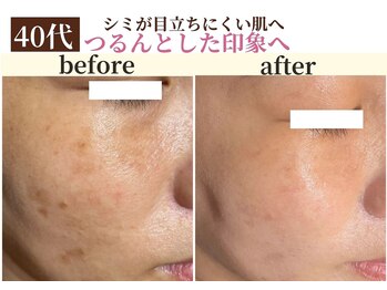 パールホワイトニング/シミケアとホワイトニングで艶肌