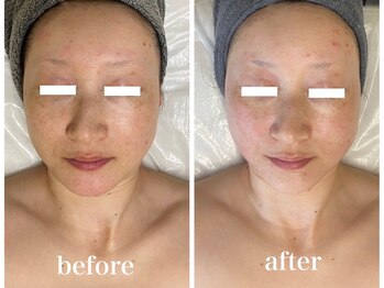 ディアンヌ(Diane)/小顔/口元ゆがみ/巻き肩首コリ