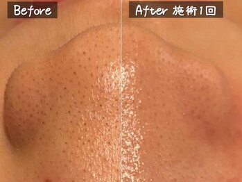 ココモンド(COCOMONDO)/ハイドロ毛穴洗浄/毛穴/毛穴洗浄