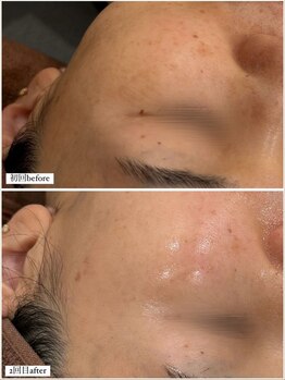 オリエンタルビューティー(ORIENTAL BEAUTY)/プラズマフェイシャル