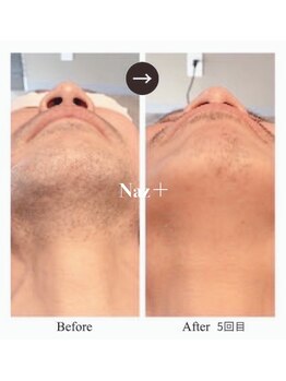 リベルテ(Liberte)/メンズ顔脱毛