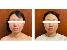 ニコワ(Nicowa)/Nicowaのコルギ★BeforeAfter