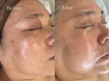 イースト(EAST)/シミプラズマ3回フォト1回/2ヶ月