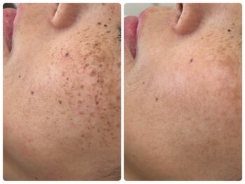 アンド ユー(and.yu)の写真/【本気のシミケア】国内最高峰スペックの最新美容機器AMATERASU導入サロン♪結果重視のシミしわケア◎