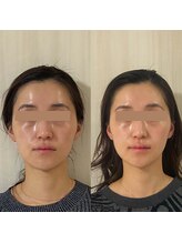 サロン ウェル(SALON WELL)/【小顔/ハーブピーリング】