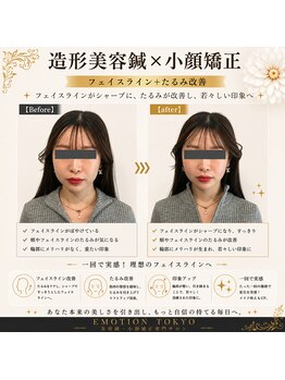 エモシオン トウキョウ(EMOTION TOKYO)/造形美容鍼×小顔矯正