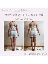 ルシアル(Rucial)/痩身◇ビフォー／アフター