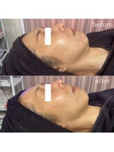 スピカ(Spica)/テラボーラー＆幹細胞→3回施術