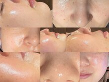 エスケア(S-CARE)/脱毛でモチツヤ肌に☆