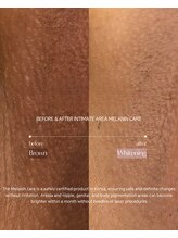 エクスクラメーションマーク(!!!)/気になる黒ずみに！