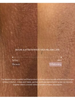 エクスクラメーションマーク(!!!)/気になる黒ずみに!