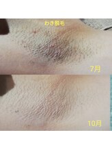 RiとBiのたまご/（速効脱毛）　ワキ脱毛　3ヵ月