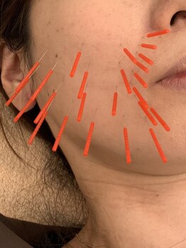 はしもと鍼灸整骨院/◇美容鍼灸