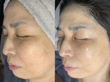 キー(kii)/フェイスライン引き上げ