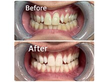 ご家族やお友達と一緒にホワイトニングを受けることもできます♪