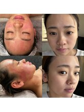 リアンボーテ(Lien Beaute)/ホワイトハーブピーリング