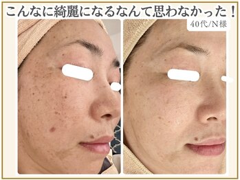 ポモナ 横浜馬車道店(Pomona)/シミケア/シミ改善 毛穴も改善◎