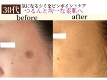 パールホワイトニング/出産後に濃くなったシミ改善