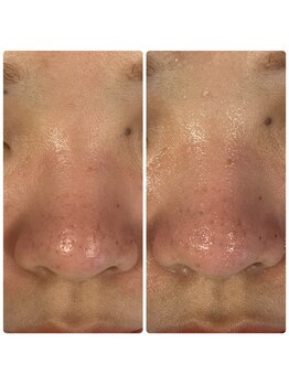 ハーシークレット(Her secret)/ハイドラ毛穴洗浄