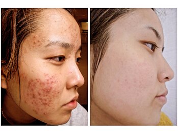 ゾーンビューティーハウス 松戸店(ZONE BEAUTY HOUSE)/ニキビケア(肌トラブルケア)