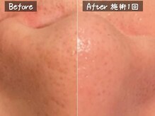 ココモンド(COCOMONDO)/ハイドロ毛穴洗浄/毛穴/毛穴洗浄