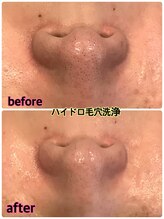 リソル(RISOL)/気になる鼻の黒ずみに!毛穴洗浄