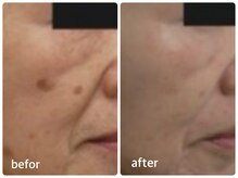 エミー(emy)/江坂/毛穴/ハーブピーリング