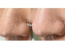 リベルテ(Liberte)/メンズ毛穴ケア