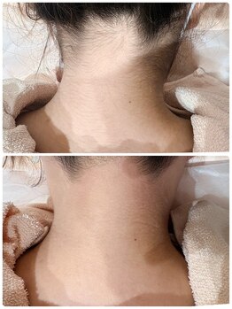 ウェイビーズ エステ(wavy's.esthetic)/【ビフォーアフター】うなじ脱毛