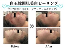 スパイア(SPIRE)/白玉韓国肌美白ピーリング★